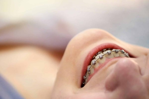Avez-vous des conseils pour les appareils orthodontiques ?